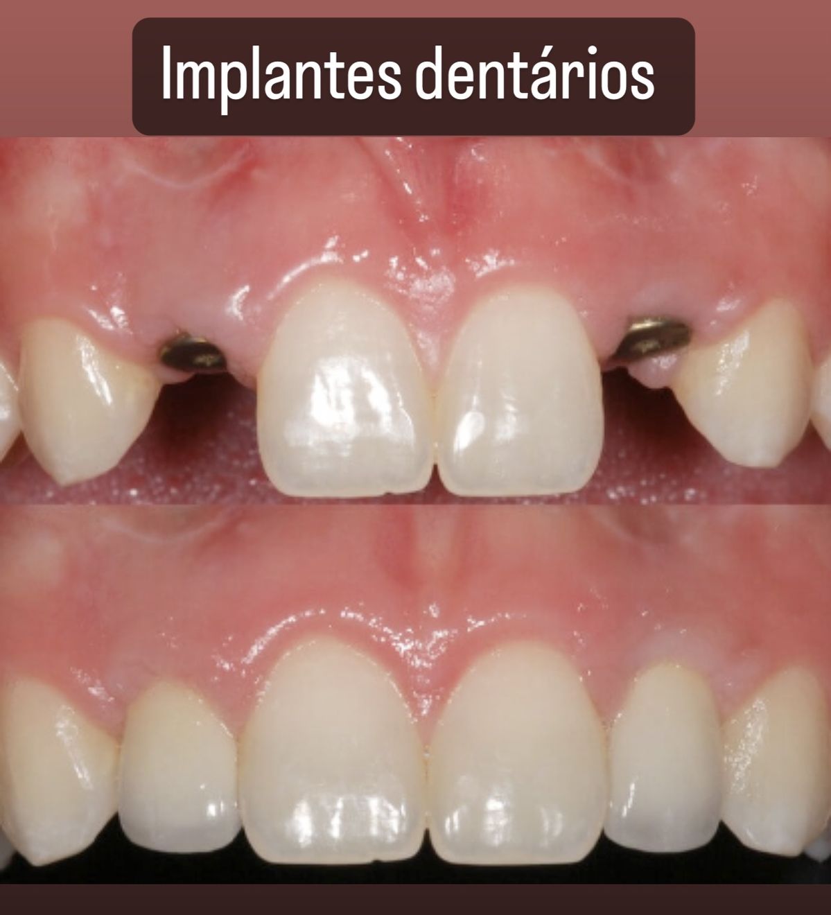 Cas clinique implant dentaire Dr. Sallahi Rabat 1