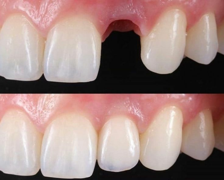 Cas clinique implant dentaire Dr. Sallahi Rabat 3