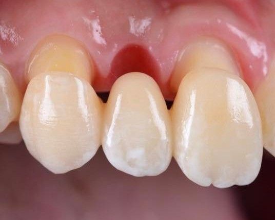 Préparation des dents avant pose de couronnes – abutments dentaires