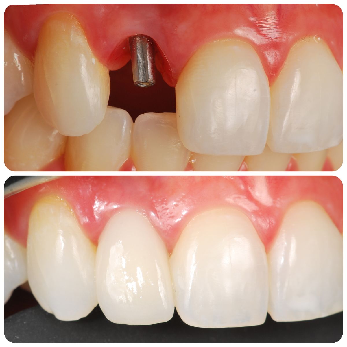 Cas clinique implant dentaire Dr. Sallahi Rabat 4