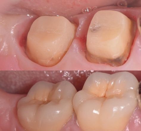 Avant après couronne molaires – restauration dents postérieures