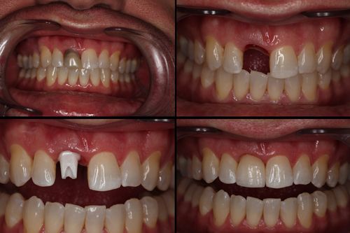 Cas clinique implant dentaire Dr. Sallahi Rabat 2