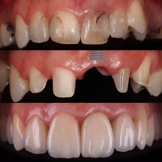 Cas clinique implant dentaire Dr. Sallahi Rabat 5